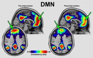 Source: Cereset Research clinical study; fMRI image showing changes in the default mode network (DMN) before and after noninvasive Cereset sessions with permission.