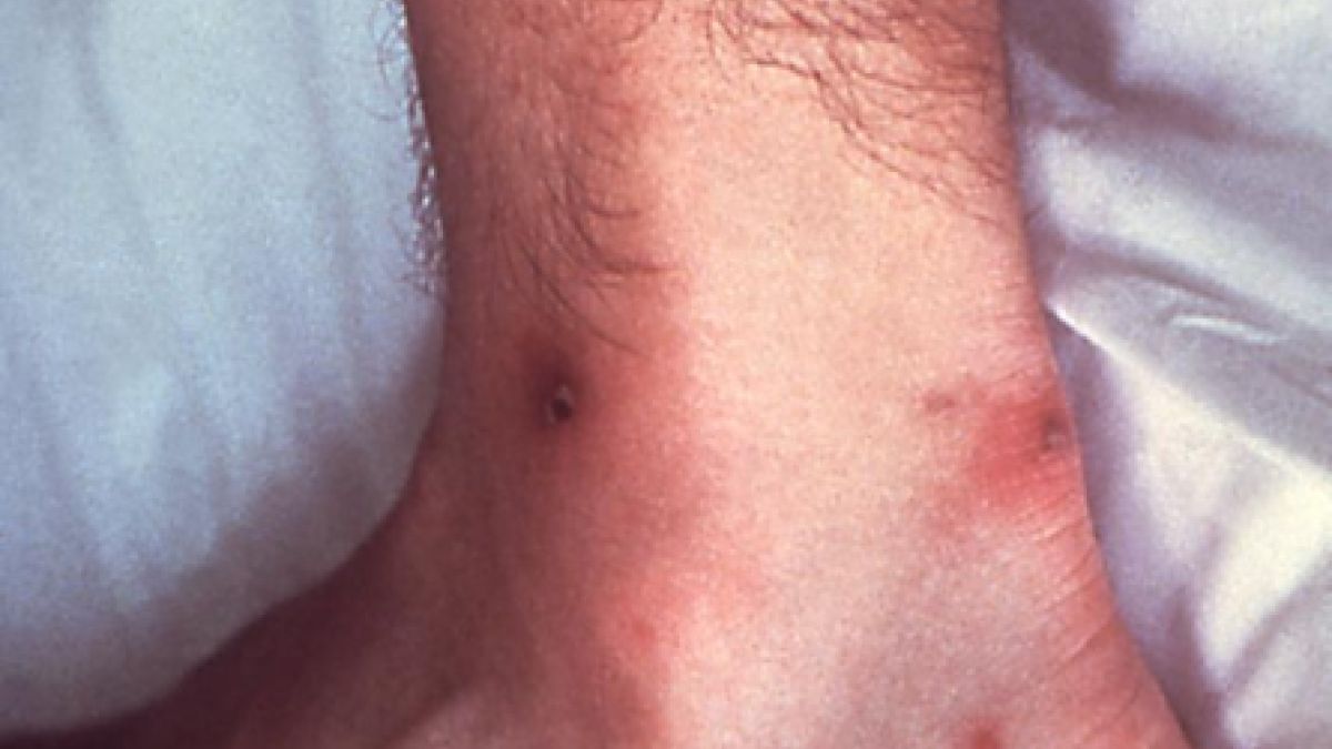 Disseminated Gonorrhea Rash