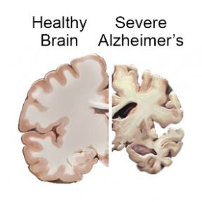 Healthy Brain and Severe AD Brain