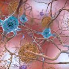 Beta-Beta-amyloid plaques and tau in the brain