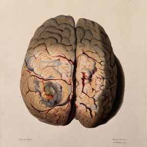 Wellcome Collection gallery:  A diseased brain. Coloured stipple etching by W. Say after F. R. Say for Richard Bright, 1829.