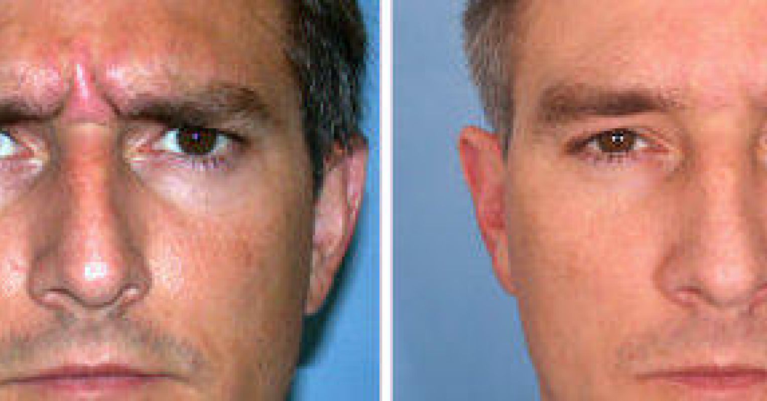 Cannot Cry Botox Does Botox Blunt Emotions? | Psychology Today