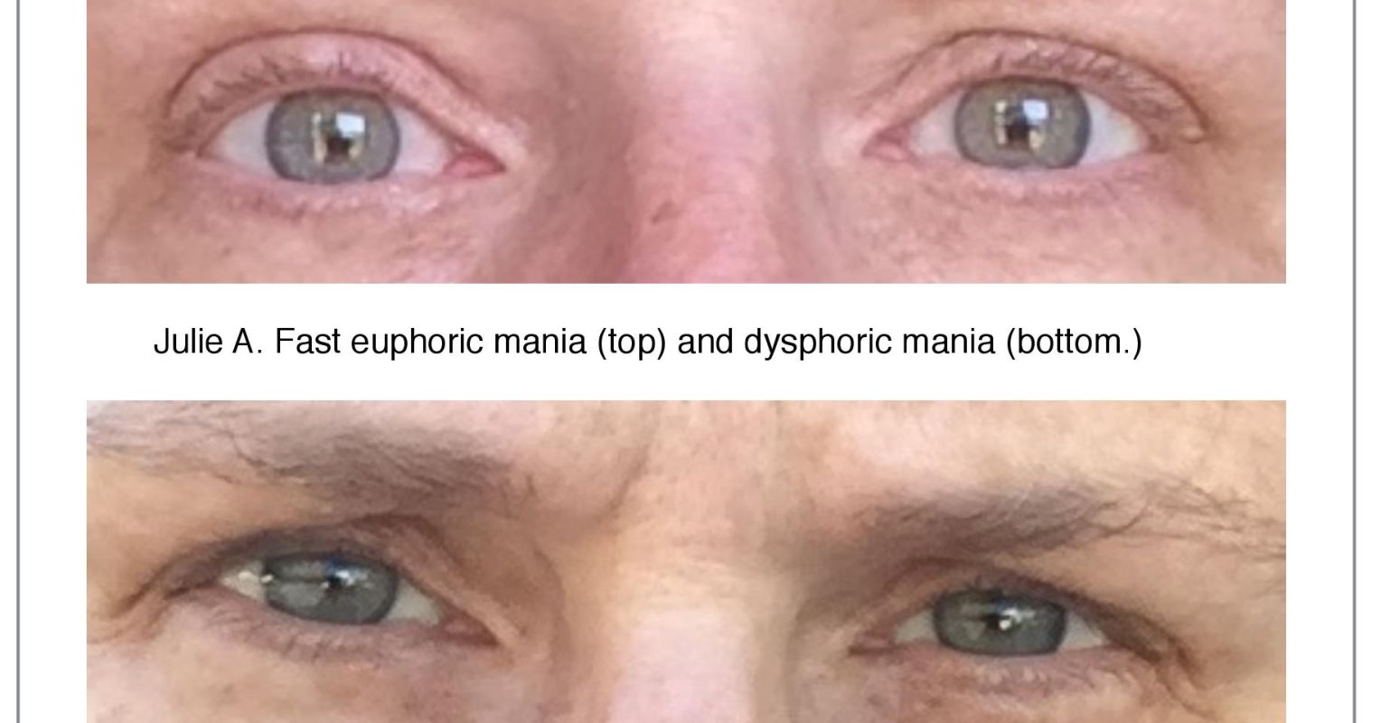 3 Clues to Recognize Bipolar Disorder Mania in the Eyes