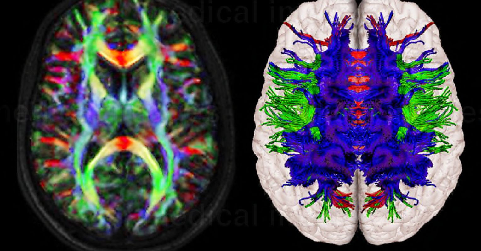 Why White Matter Matters: Diffusion Tensor Imaging | Psychology 