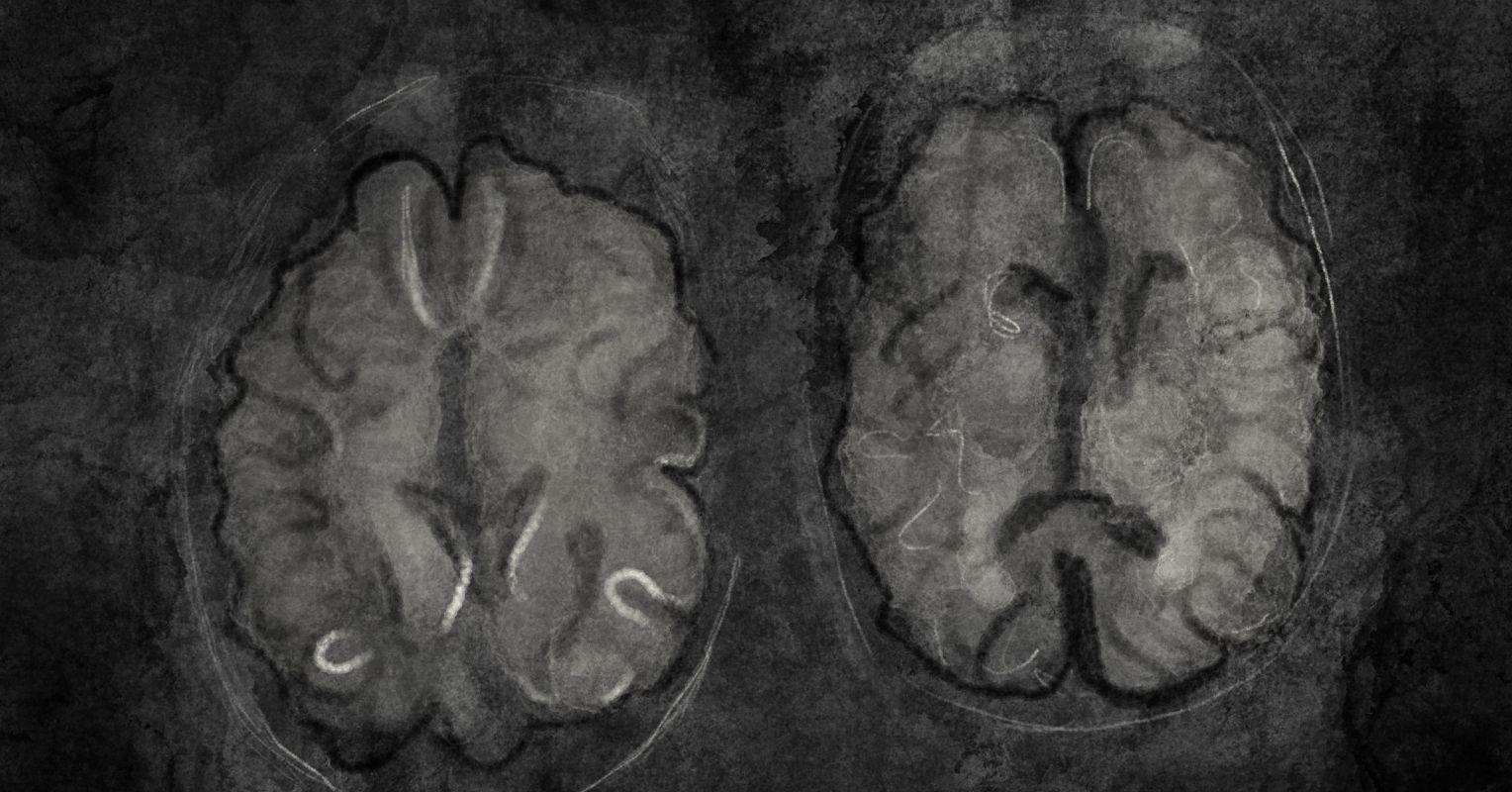 psychosis brain scan
