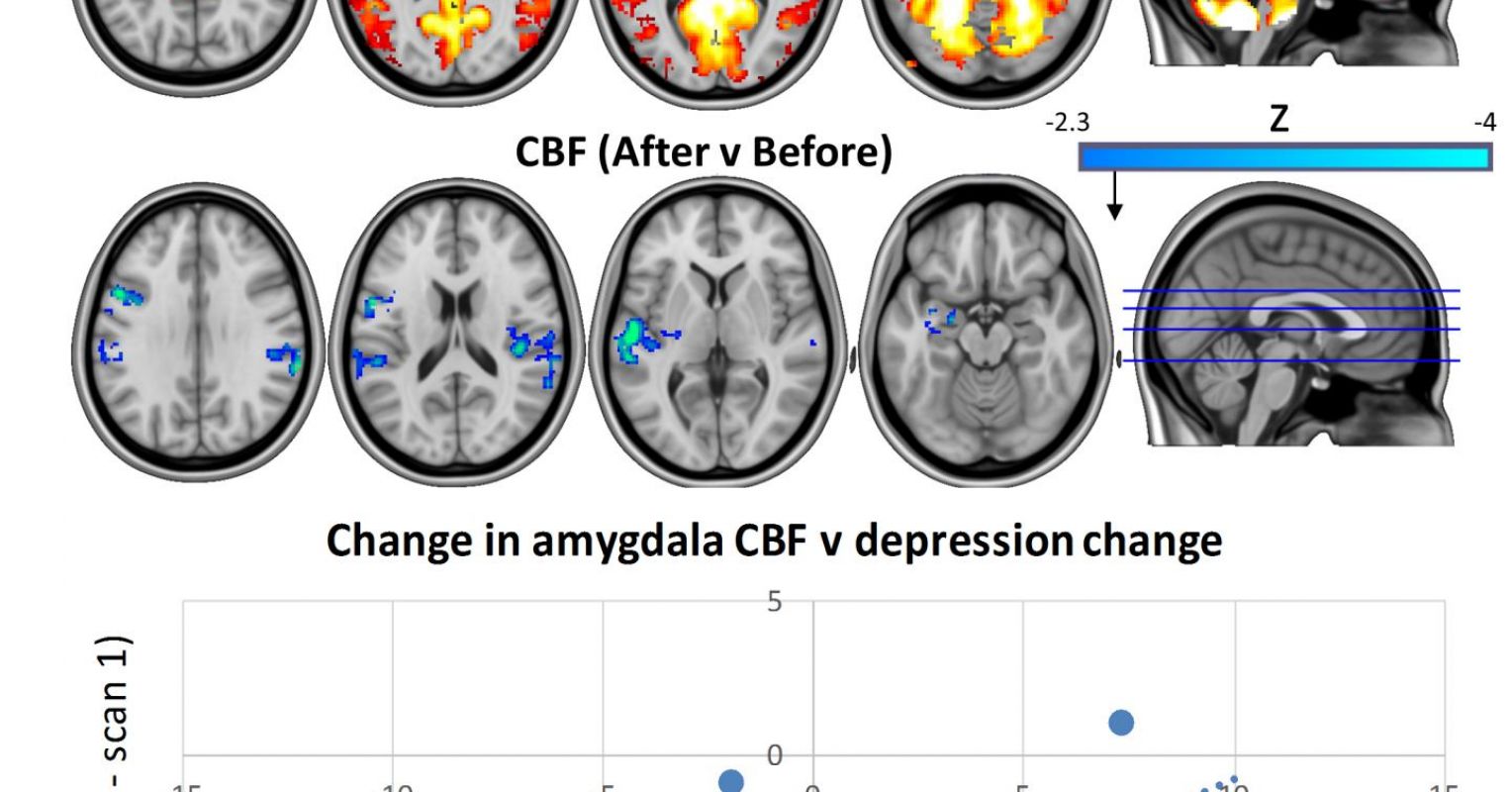 Magic mushrooms help people with depression process emotions •