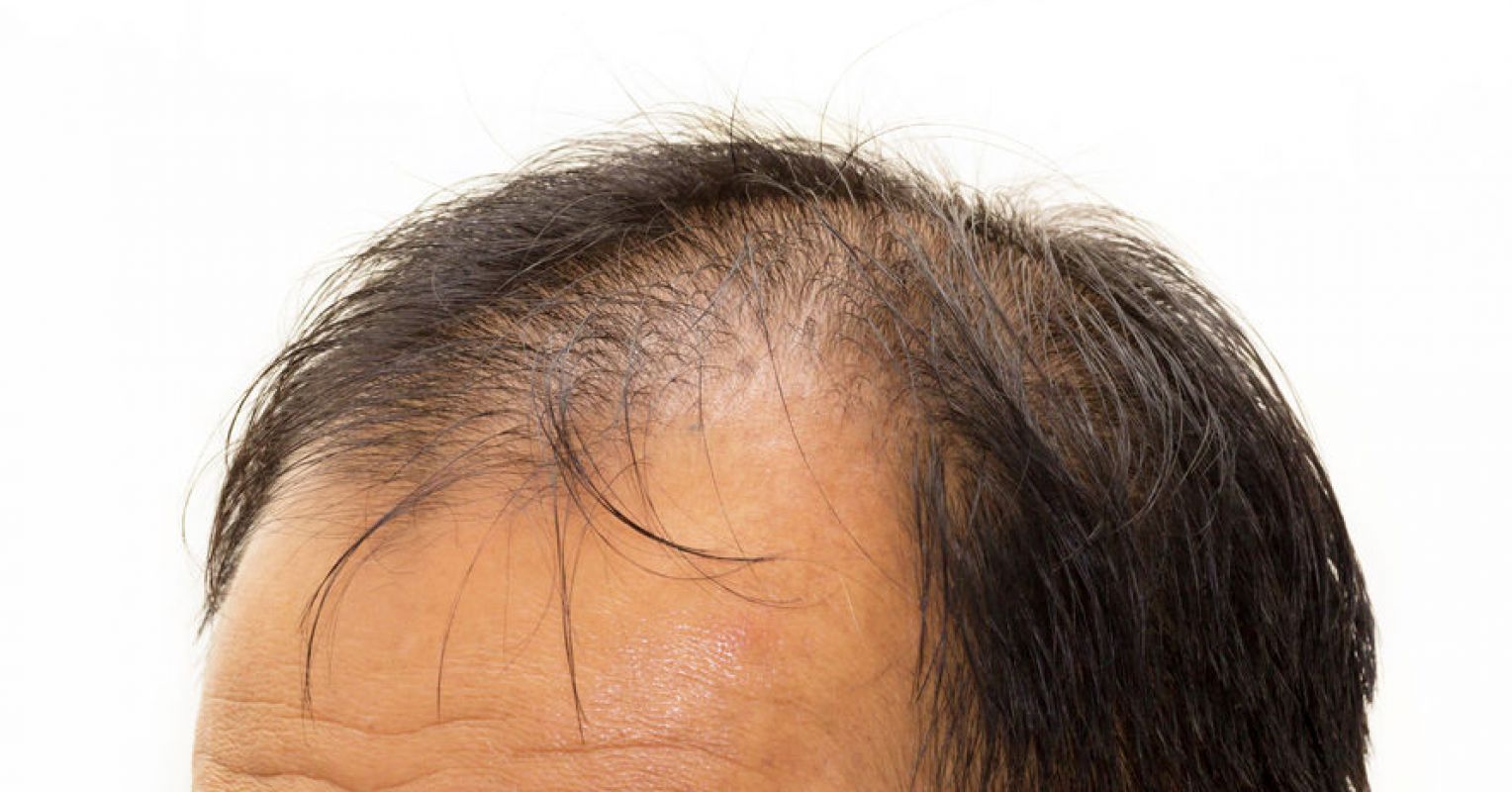 7 Ways to Treat Hair Loss | Psychology Today South Africa