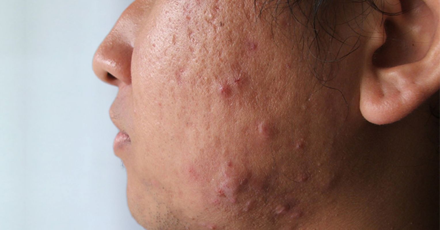 The Secret to Outsmarting Your Acne Psychology Today